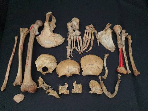 Partial antique medical real human explanatory skeleton and disarticulated skull.