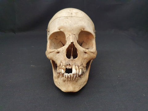 Antique medical real human skull with good colour and patina.