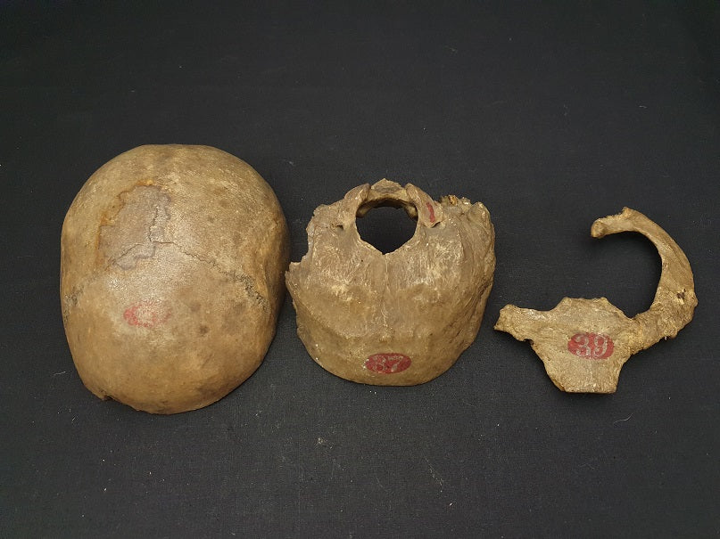 Victorian medical museum real human bones. Cranium showing advanced hyperostosis frontalis interna.