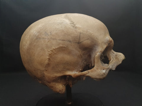 Antique deformed real human skull medical specimen