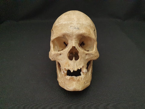 Antique medical real human skull with good colour and patina.