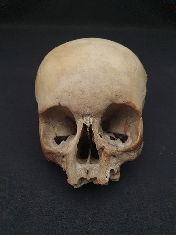Partial antique real juvenile human medical skull.