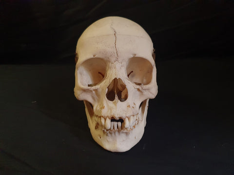 Real human medical skull showing persistent metopic suture