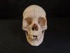 Real human medical skull showing persistent metopic suture