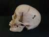 Real human medical skull showing persistent metopic suture