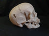 Real human medical skull showing persistent metopic suture