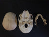 Real human medical skull showing persistent metopic suture