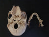 Real human medical skull showing persistent metopic suture