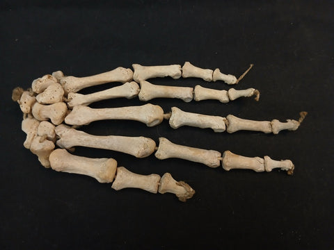 Antique real human hand medical specimen.