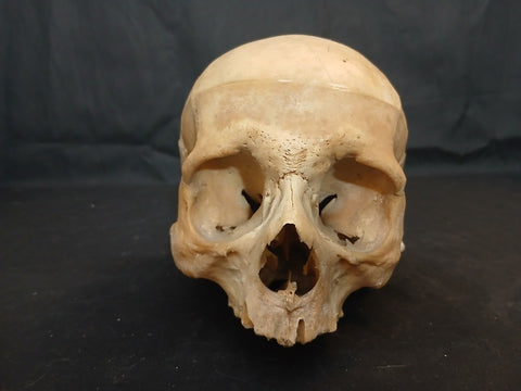 Antique partial real human skull medical specimen.