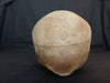 Antique partial real human skull medical specimen.