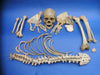 Antique Adam Rouilly medical real human half skeleton in wooden box for sale